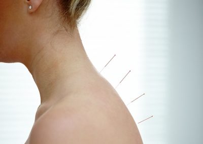 Acupuncture treatment on upper spine area
