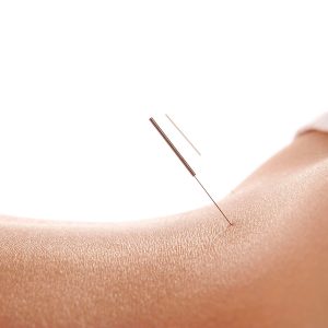Acupuncture treatment on lower back