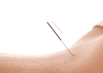 Acupuncture treatment on lower back